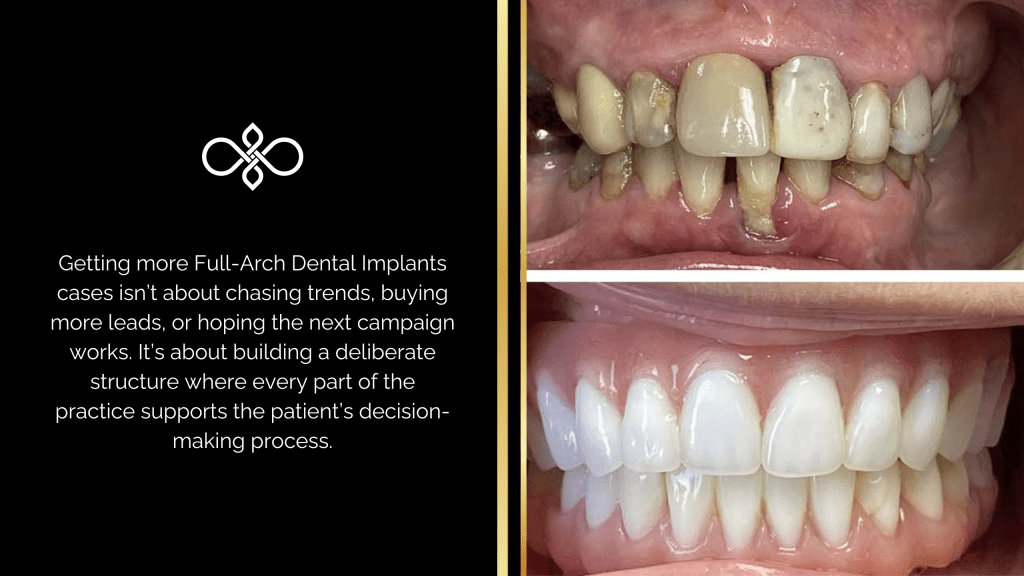 Full-Arch Dental Implants
